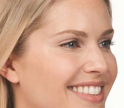 Patient after Botox® treatment