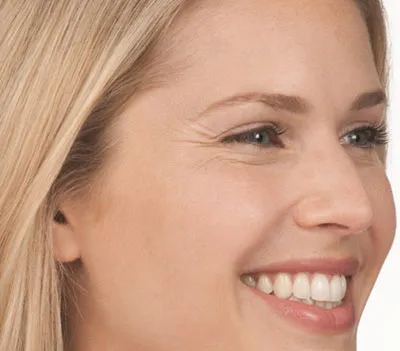 Patient before Botox® treatment