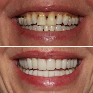 Before & After Dental work