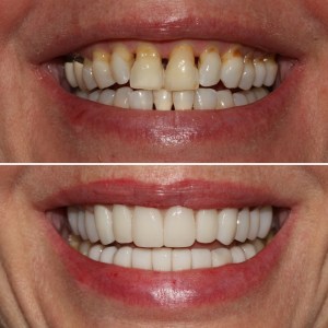 Before & After Dental work