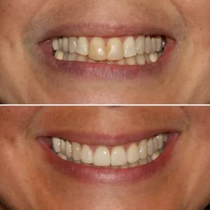 Before & After Dental work