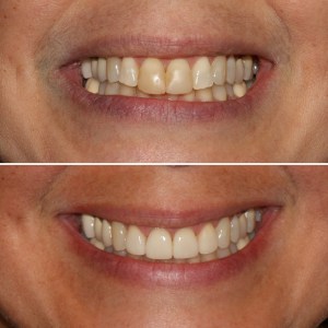 Before & After Dental work