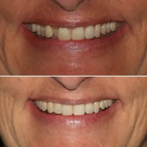 Before & After Dental work