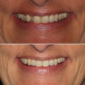 Before & After Dental work