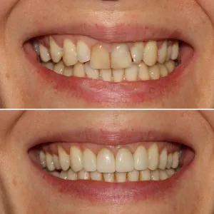 Before & After Dental work